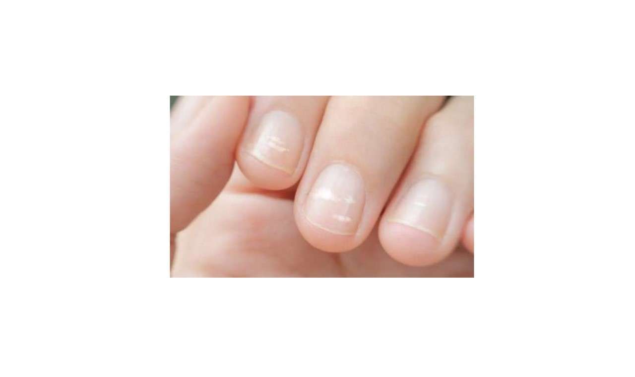 get rid of white spots on nails